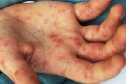 Uttarakhand Tomato Flu Spreading On Children