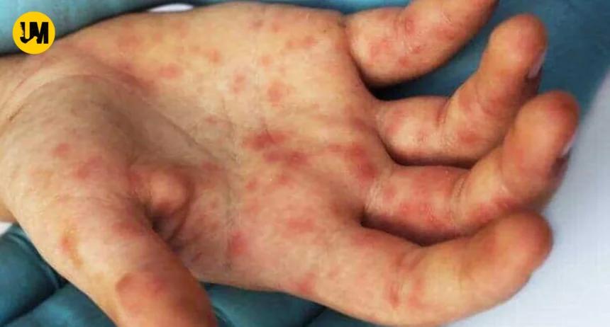 Uttarakhand Tomato Flu Spreading On Children